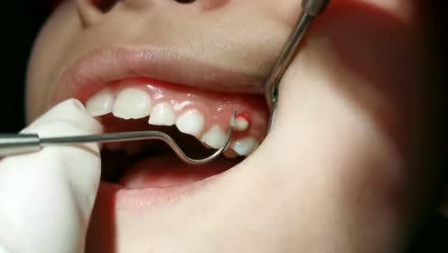 儿童牙龈肿胀流脓