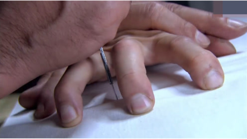 0:00:12身上被针灸大夫扎上长长的"芒针",是一种什么样的体验?