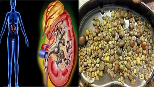 男子"保命肾"长满结石 右肾萎缩20年毫无感觉