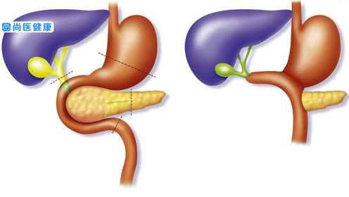 胆囊癌根治术 腾讯视频