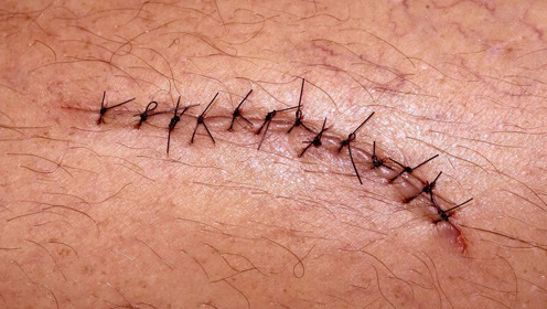 手绘伤口缝线,简直能以假乱真了!