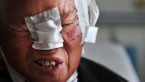 老太婆满头是血,耳朵被插入7公分的钉子,检查吓坏在场所有人!