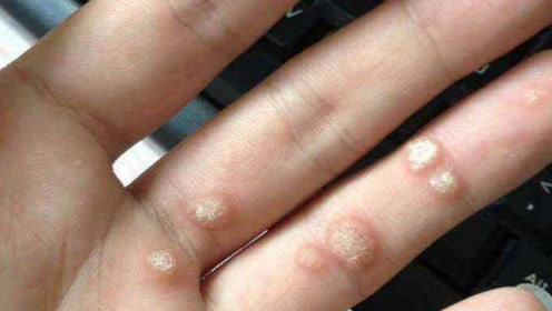 手上有瘊子太难看了,农村奶奶教我一个土方法,瘊子自动脱落了