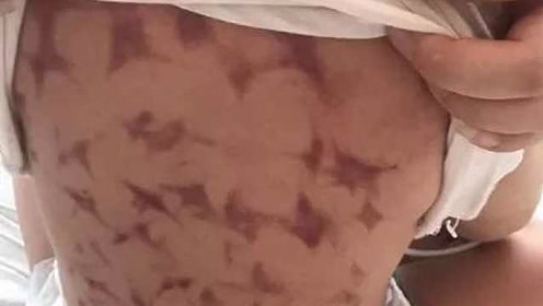 被掐伤 腾讯视频