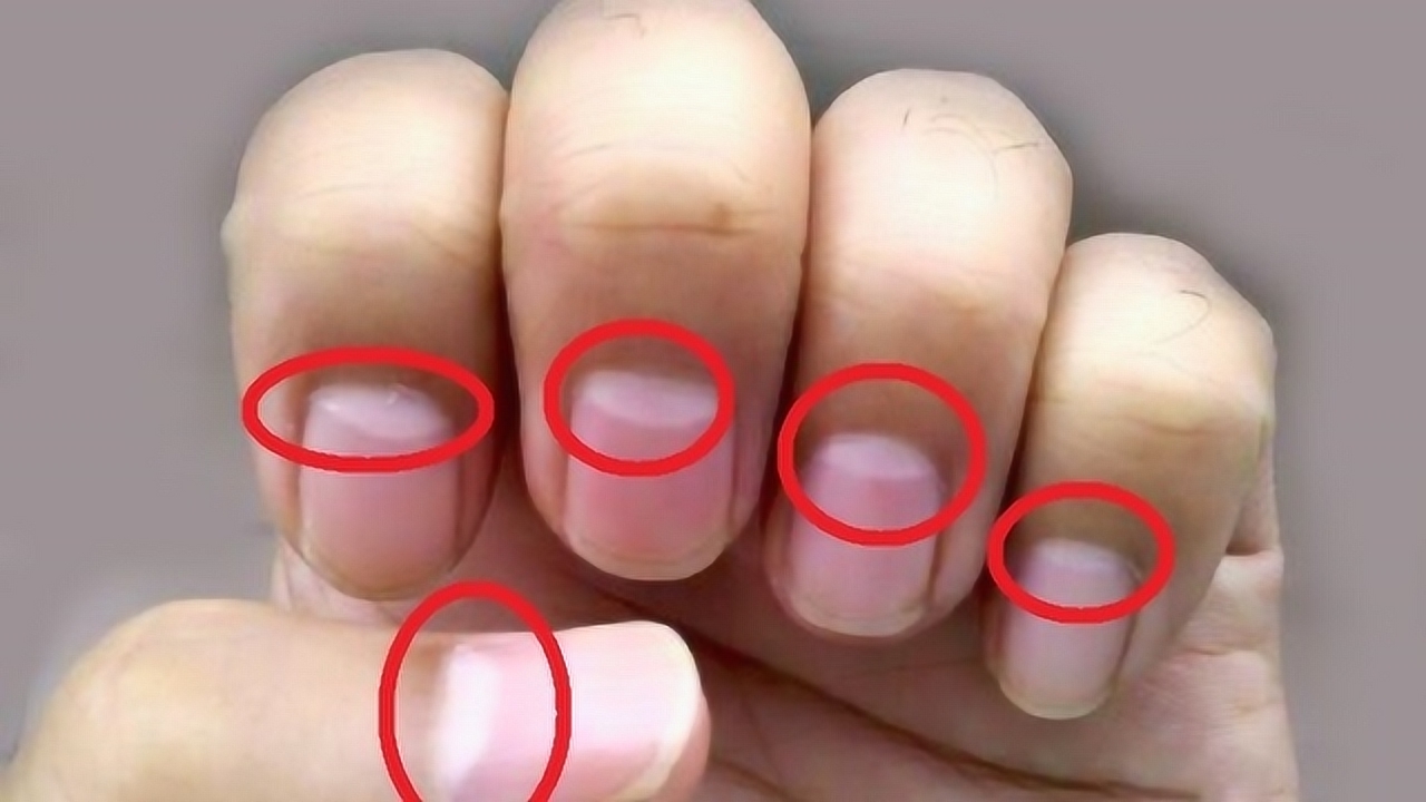 指甲上月牙别不当回事,它的每一次变化,都是身体发出的求救信号