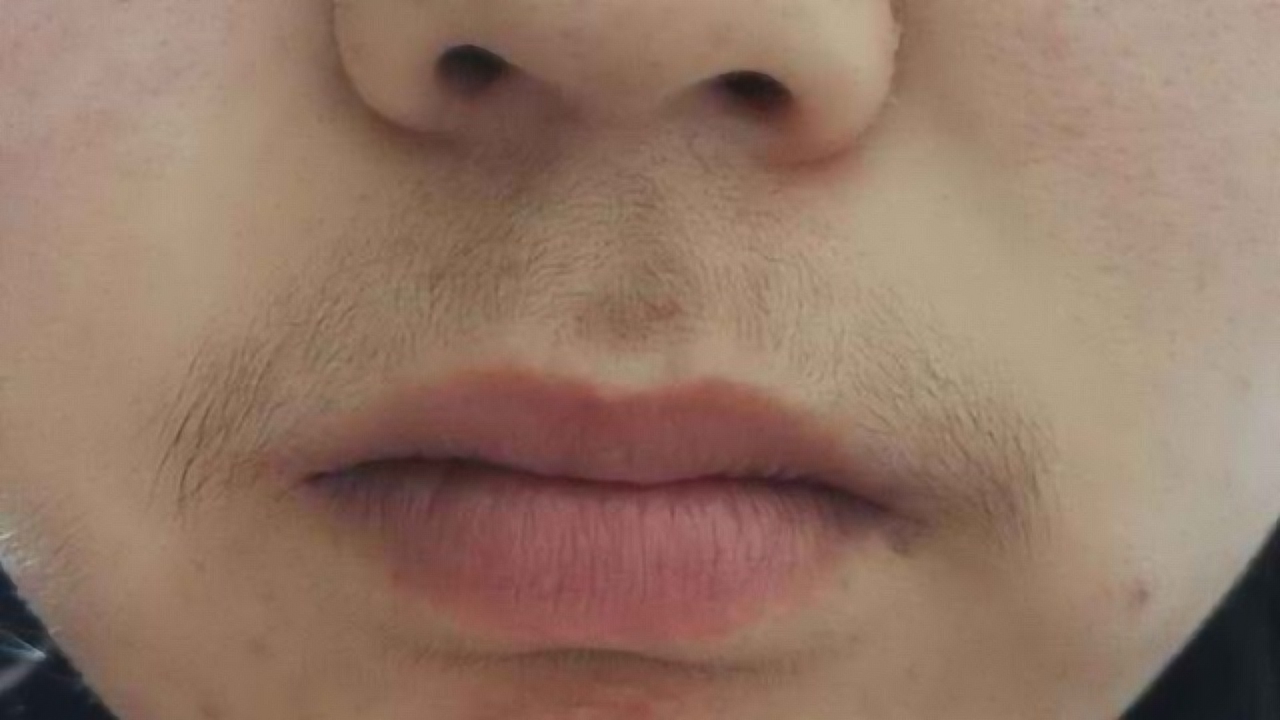 女生唇毛太重太难看千万别傻傻的剃掉用这招让唇毛不再长