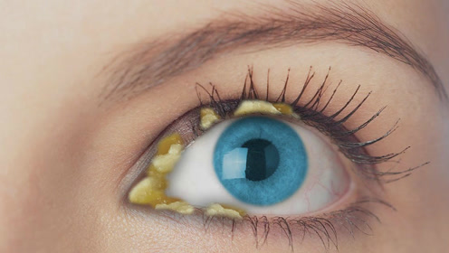 人为什么有眼屎?