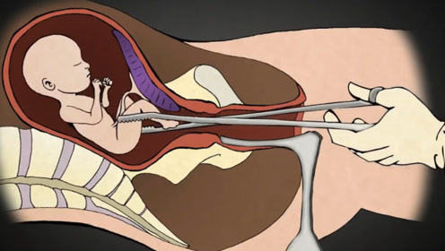 人流手术是怎样拿掉孩子的?3d动画演示全过程,看完一阵揪心!