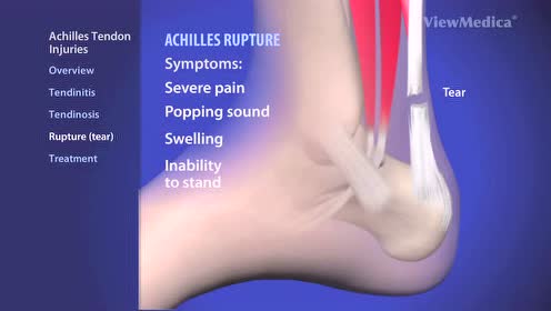 跟腱损伤 腾讯视频