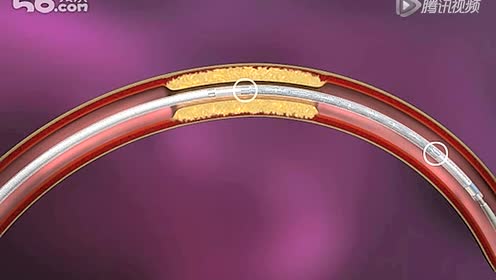 上传者:aaron chen时 间:2017-01-21wingspan支架治疗icad0:02:00简