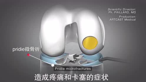 膝关节软骨修复 腾讯视频