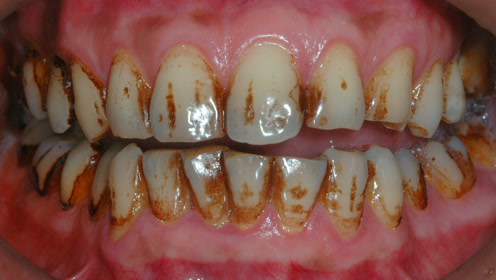 牙齿根部总出现黄色污垢?5分钟就能根除,比珍珠还白!