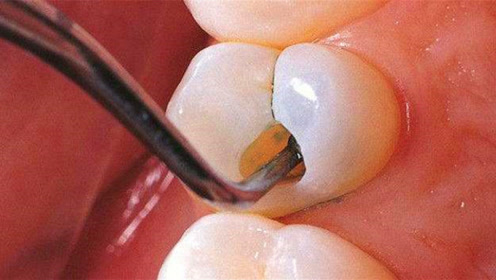 最烂的牙齿坏牙龋齿图片图片下载图片id873772人体器官图片素材聚图2