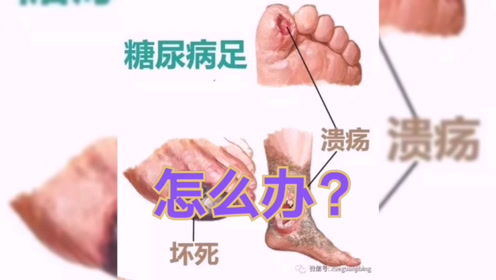 溃疡糖尿病足 腾讯视频