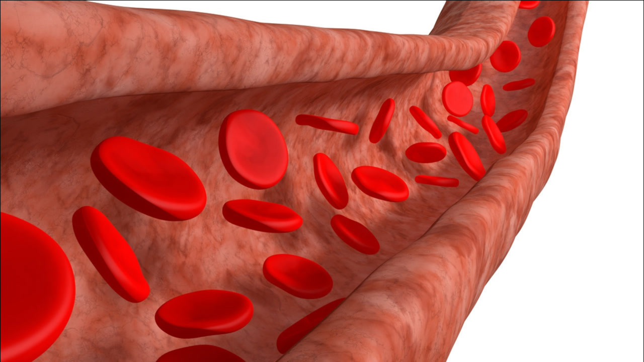 治疗血管斑块,1剂中药方疏通血管淤堵,堵塞70降到30