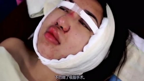 23岁女孩整容失败 脸部毁容 后悔莫及 腾讯视频