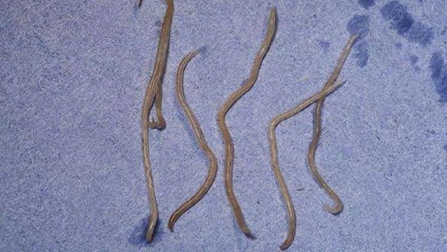 宁波大妈小肠里住了一群蛔虫, 把医生吓得目瞪口呆