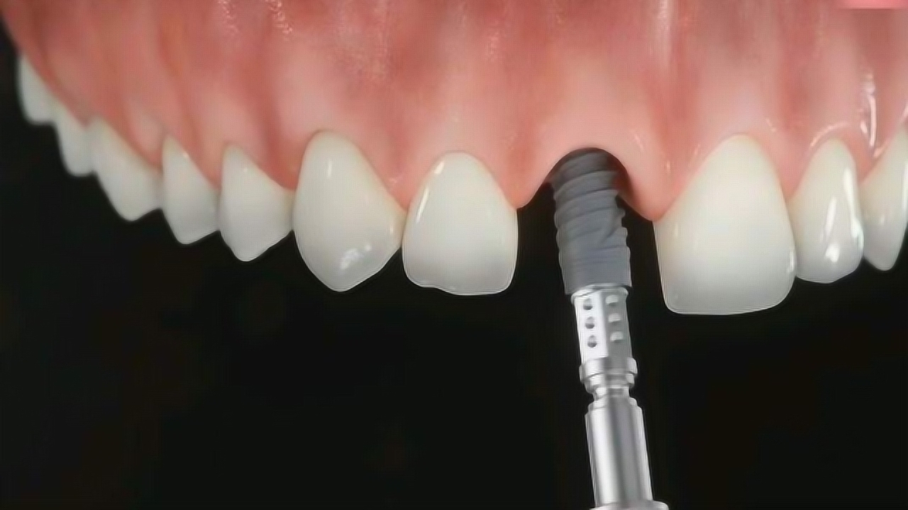 前门牙缺失种植牙,即拔即种式修复过程,大开眼界!