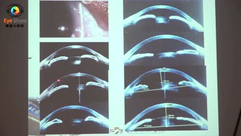 眼科oct 腾讯视频