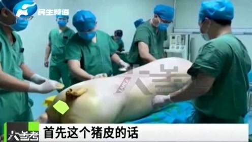 全身大面积烫伤 腾讯视频