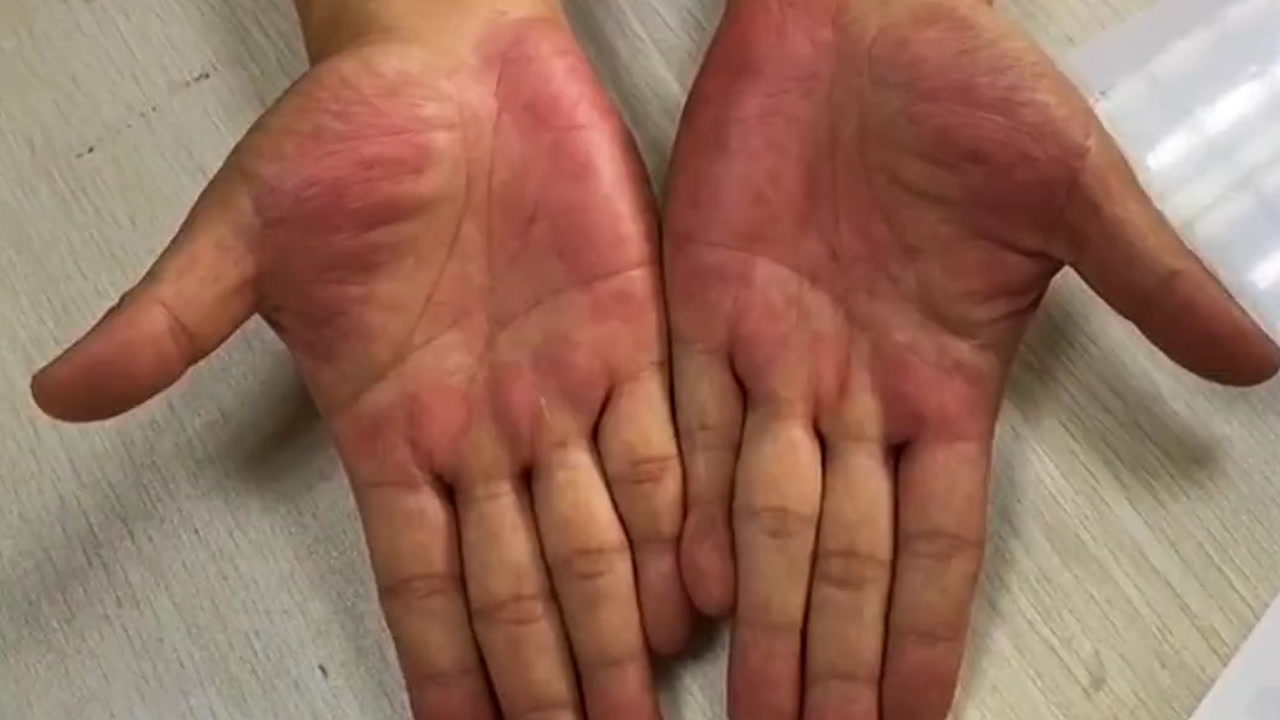 患乙肝男子不舒服去医院检查,医生看手掌后大惊失色:不祥征兆!