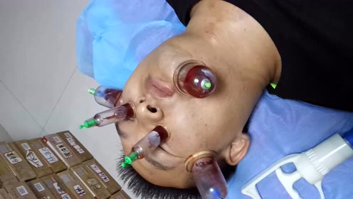 面部痤疮 青春痘 拔罐放血视频录像 培训