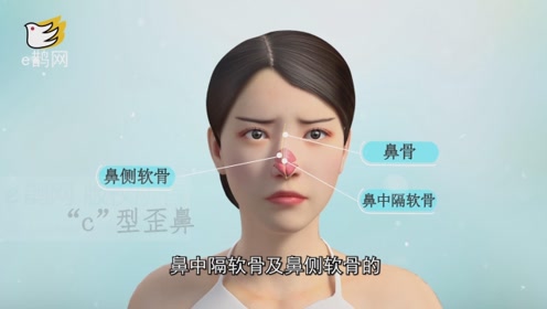 歪鼻矫正 腾讯视频