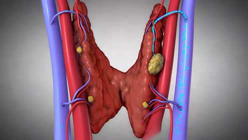 [图]3D动画演示甲状旁腺功能亢进病理，知其然还要知其所以然