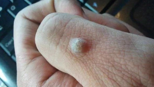 身上长瘊子太难看,教你去除猴子土办法,几天时间瘊子自动消失