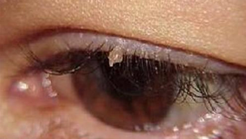 并且好发于眼睑,头皮?如何鉴别丝状疣?