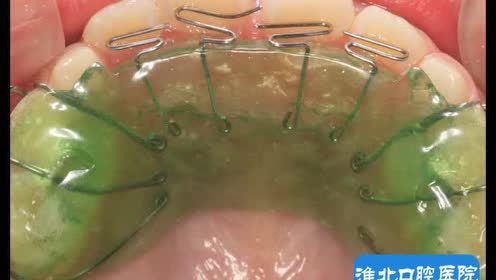 儿童反颌颌垫 舌簧矫治器