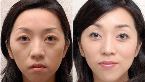 经常打玻尿酸的女人,10年后脸部成这样,看完你还敢整容吗?