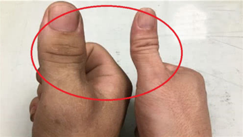 一旦手指出现这些症状,可能是身体发出的"患癌信号"
