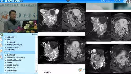 女性盆腔的mr诊断 腾讯视频