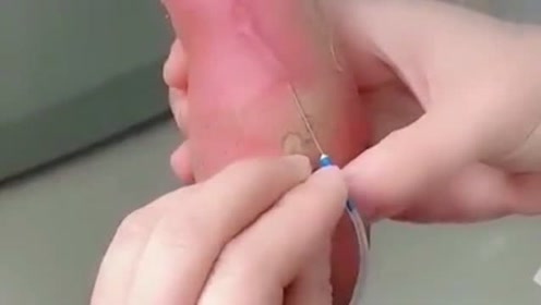 找血管 腾讯视频
