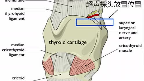 超声引导甲状软骨上缘喉上神经间隙阻滞(厦门中山医院柴彬)
