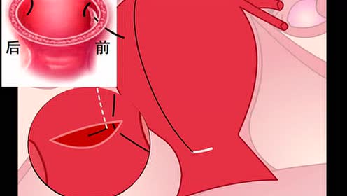 龚晓明医生讲b-lynch缝合法