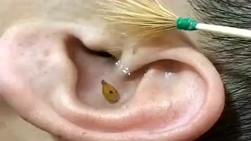 往耳朵里灌水的采耳,还用工具在耳道里搅拌,真怕稍不注意就会