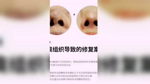 原辰鼻部整形 腾讯视频