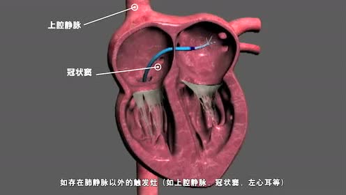 三维射频消融治术动画示意图