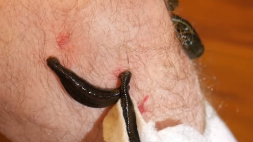 蚂蝗吸血身体图片