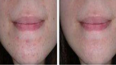 长痘怎样调理 腾讯视频