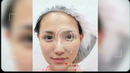 鼻子整形前后对比 腾讯视频