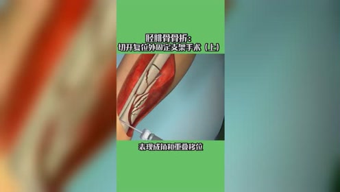 胫腓骨骨折 腾讯视频