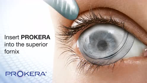 新型羊膜绷带镜04