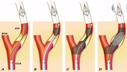 颈动脉支架植入术