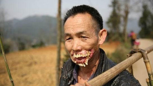 贵州一男子被狼咬后牙齿外翻长相恐怖