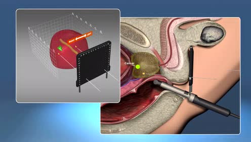 前列腺穿刺3d演示