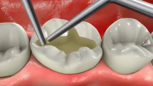 窝沟龋坏用树脂补牙的过程,牙齿龋坏趁早补牙!