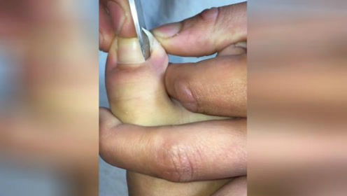 这个甲沟炎的脚趾甲有倒刺挺疼的!